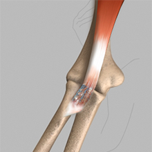 Biceps Tendon Tear at the Elbow