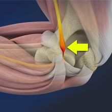 Cubital Tunnel Syndrome