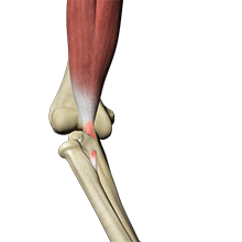 Distal Biceps Rupture