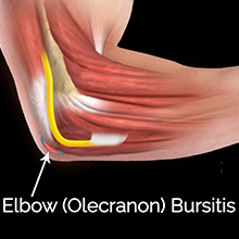 Elbow (Olecranon) Bursitis