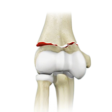 Elbow Fractures