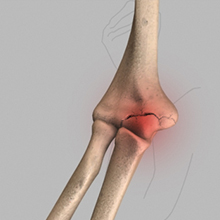 Elbow Injuries in the Throwing Athlete