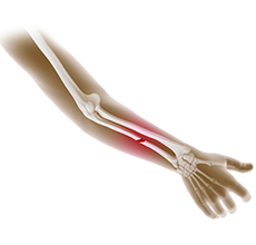 Forearm Fractures in Children