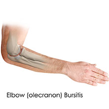 Osteochondritis Dissecans