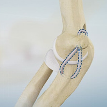 Ulnar Collateral Ligament Reconstruction