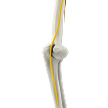 Ulnar Nerve Subluxation