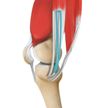 ACL Reconstruction Hamstring Tendon