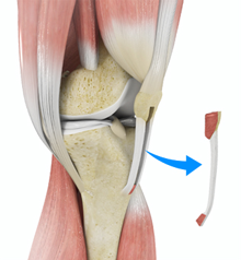 ACL Reconstruction Patellar Tendon