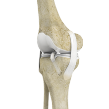 Anterior Cruciate Ligament ACL Reconstruction