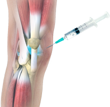 Arthrocentesis