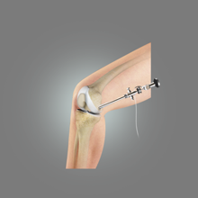 Arthroscopy of the Knee Joint