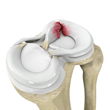 Meniscus Tear