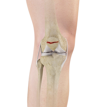 Knee Fracture