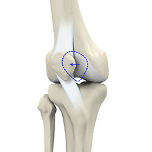 Patellar Dislocation