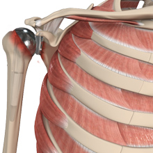 Revision of Shoulder Replacement
