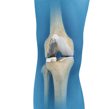 Uni condylar Knee Replacement